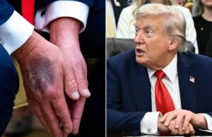 Trump oo billaabay in uu gacmihiisa mariyo dawooyin si uu u qariyo dhaawacyo ka dhashay xannuun ku dhacay!