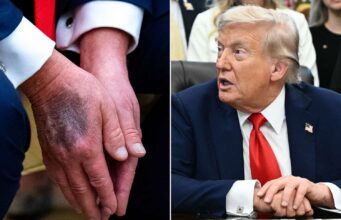 Trump oo billaabay in uu gacmihiisa mariyo dawooyin si uu u qariyo dhaawacyo ka dhashay xannuun ku dhacay!